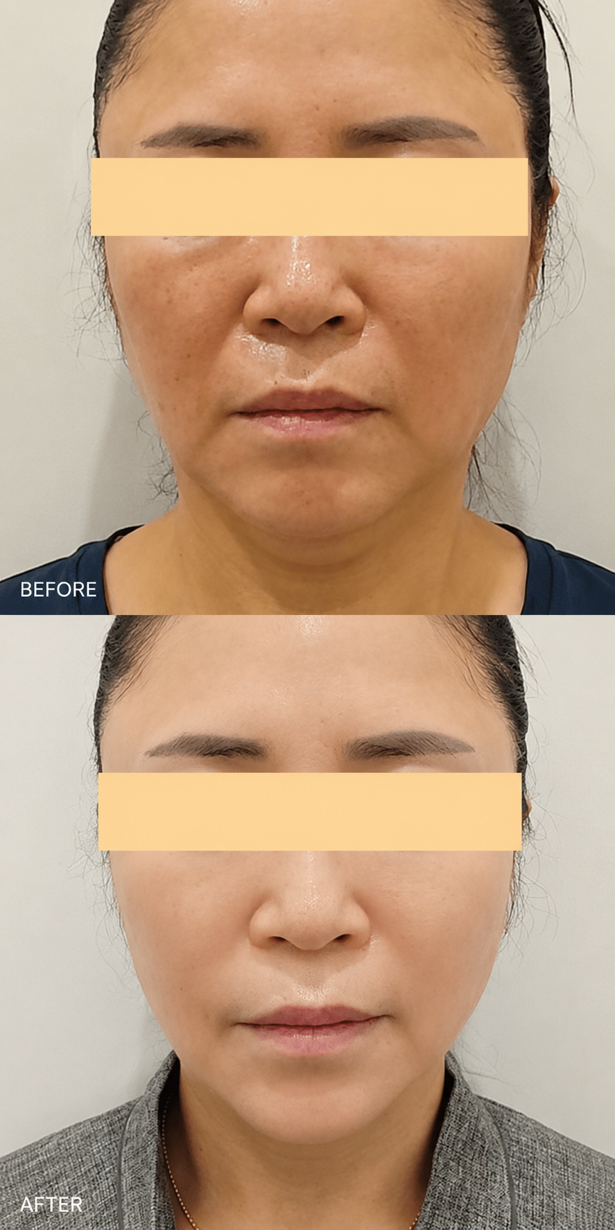 ART-CELL before and after at ARTNER Cheongdam, Gangnam, Korea