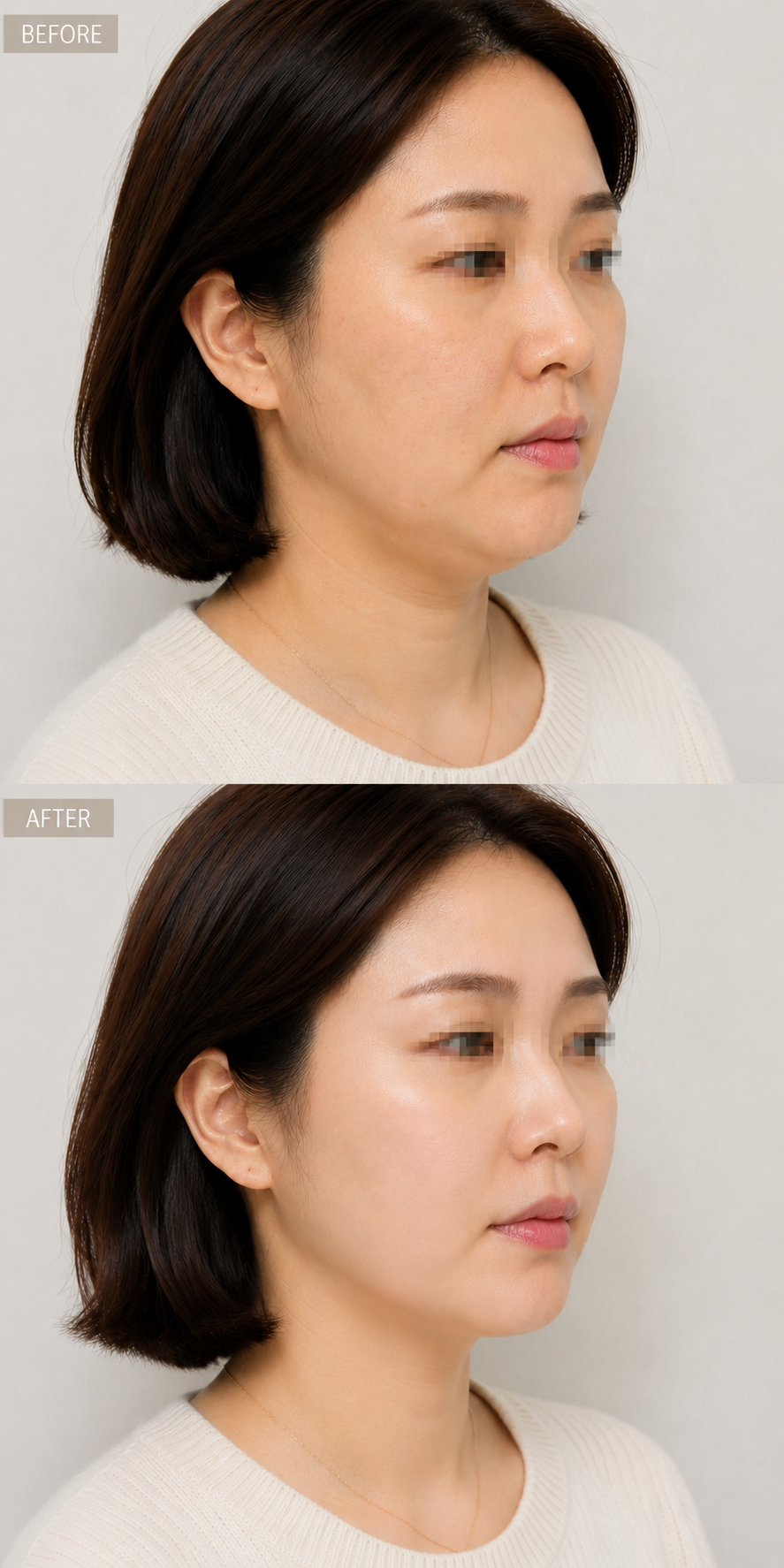 the face before and after ARTNER contouring, Cheongdam Gangnam, Korea