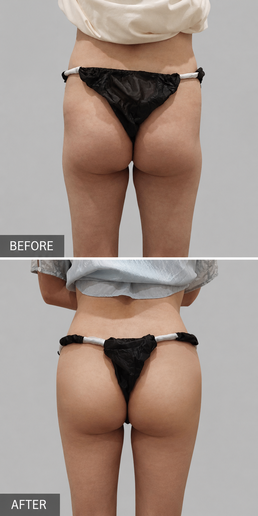 ART-TUNE hip fat-dissolving and skin tightening before and after at ARTNER Cheongdam