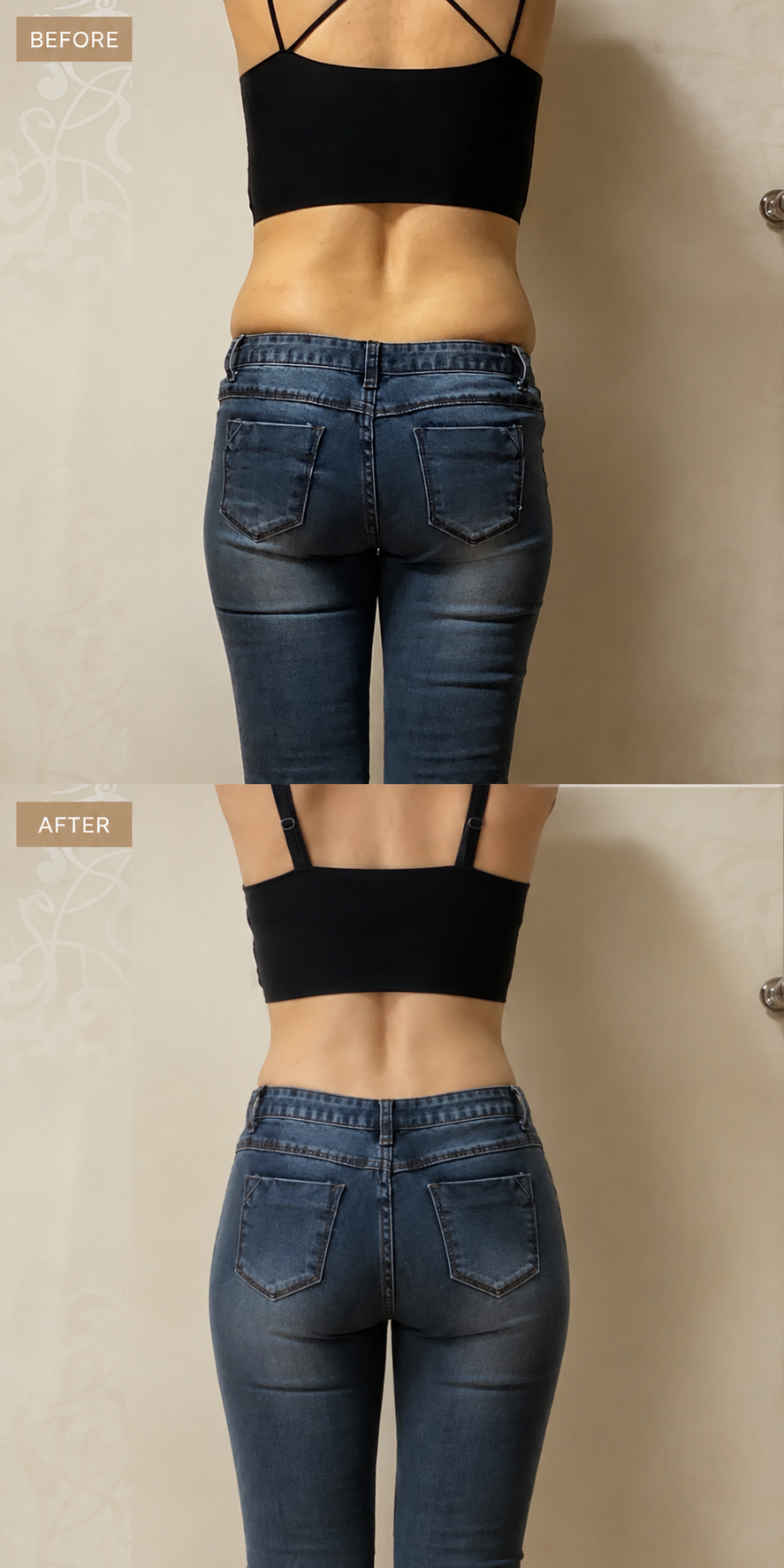 Body contouring with filler before and after