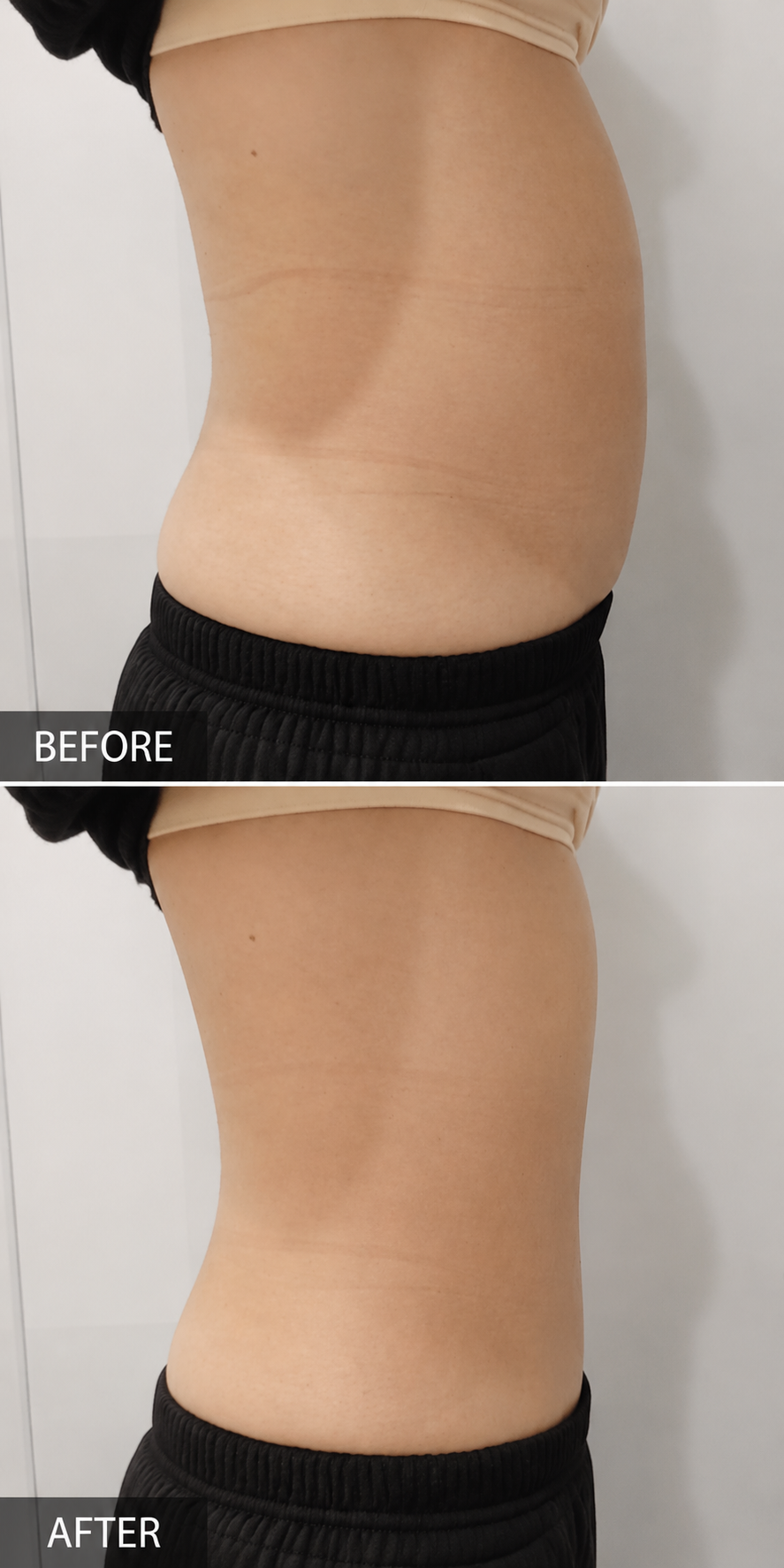 Love handle flank liposuction before and after
