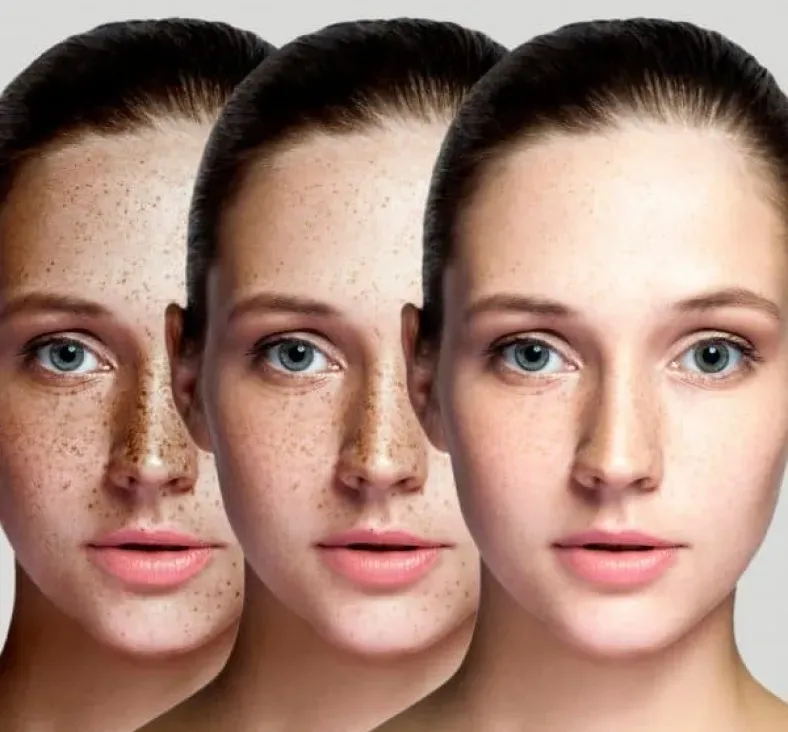 Three side-by-side female faces showing increasing skin smoothness and reduced freckles under bright lighting