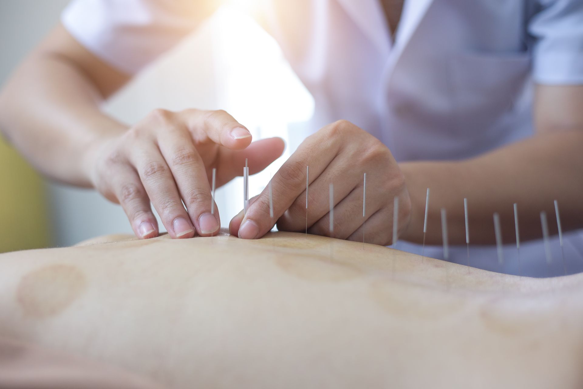 Acupuncturist inserting needles into a patient's back, alongside cupping marks.