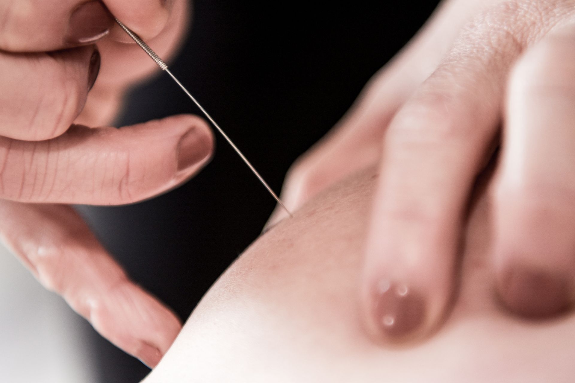 Hands inserting an acupuncture needle into the skin of an arm.