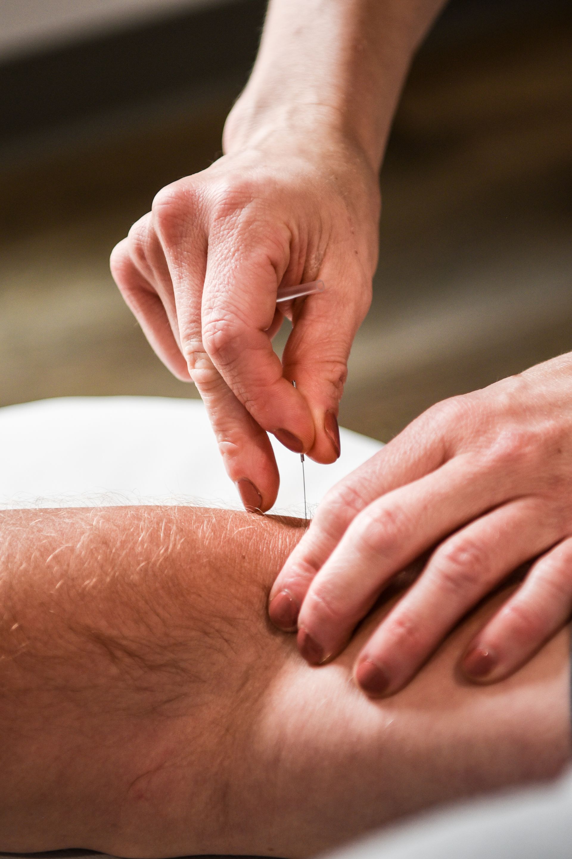 Hands inserting acupuncture needle into a person's leg.