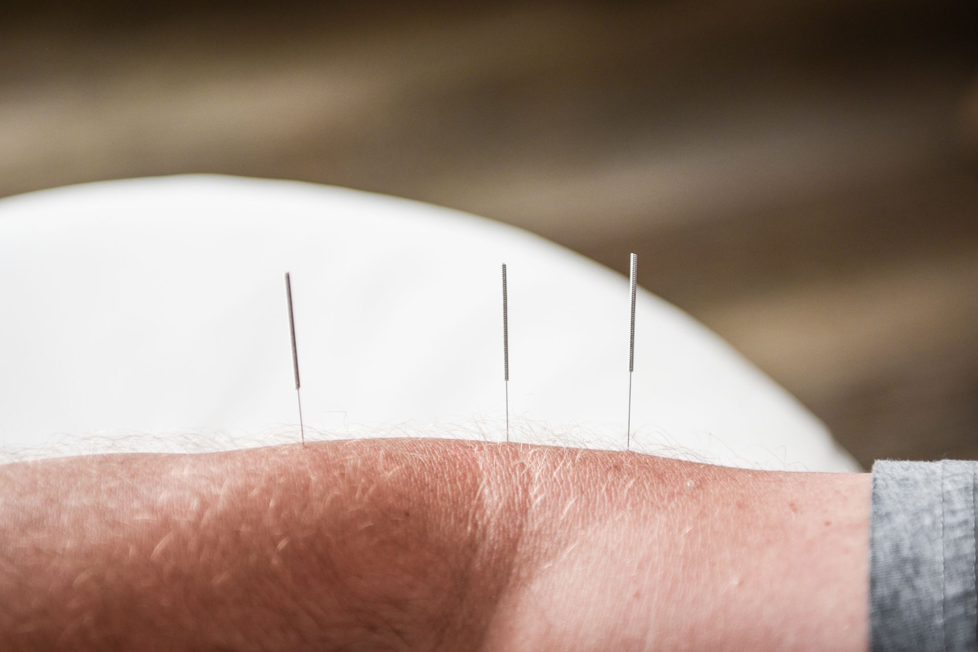 Arm with acupuncture needles inserted, white background.