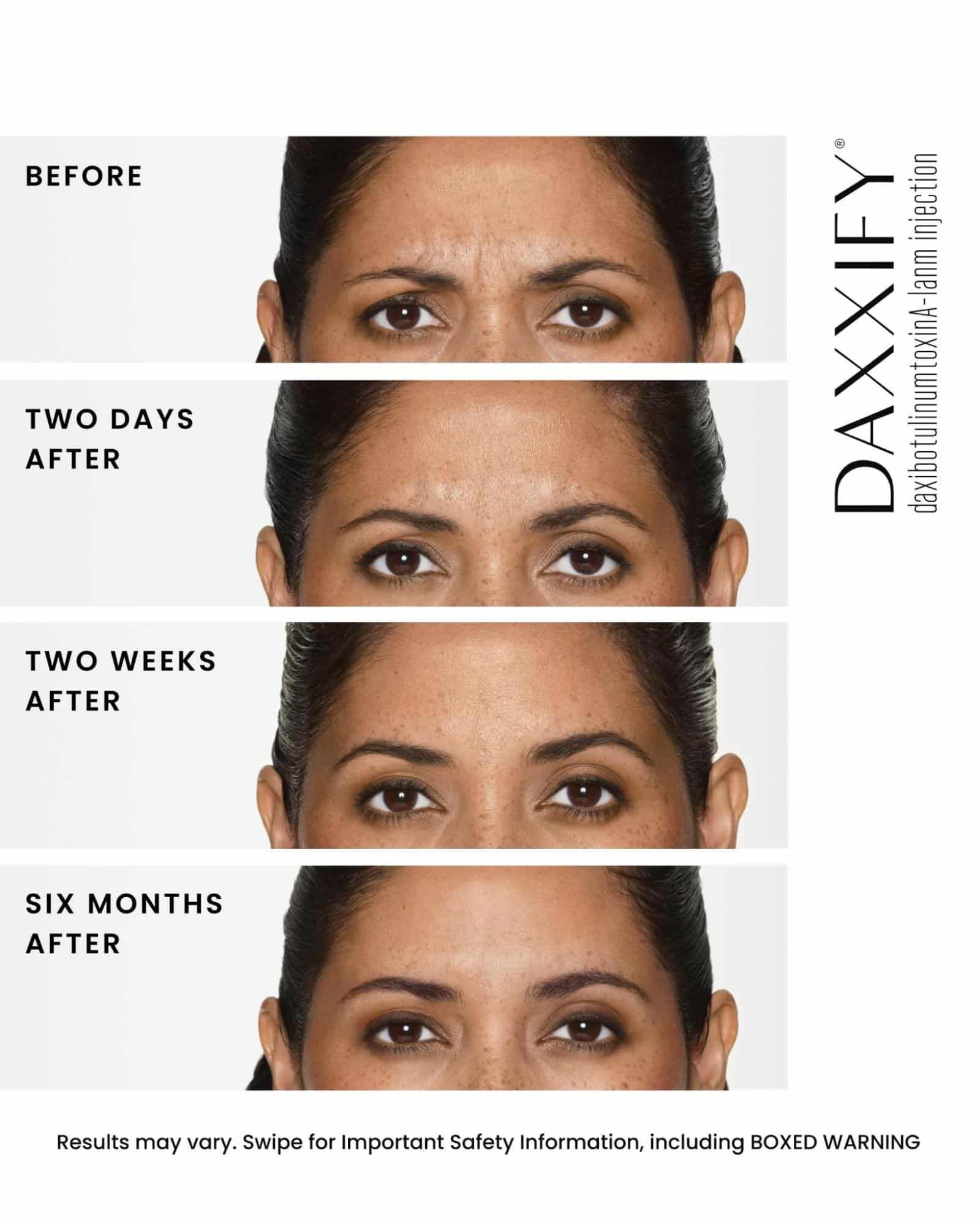 Botox before and after patient at Z Dermatology in Baton Rouge
