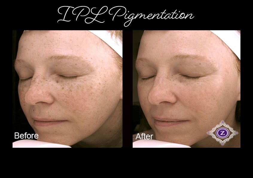 Age spot removal, IPL laser treatment, Baton Rouge, Dr. Z