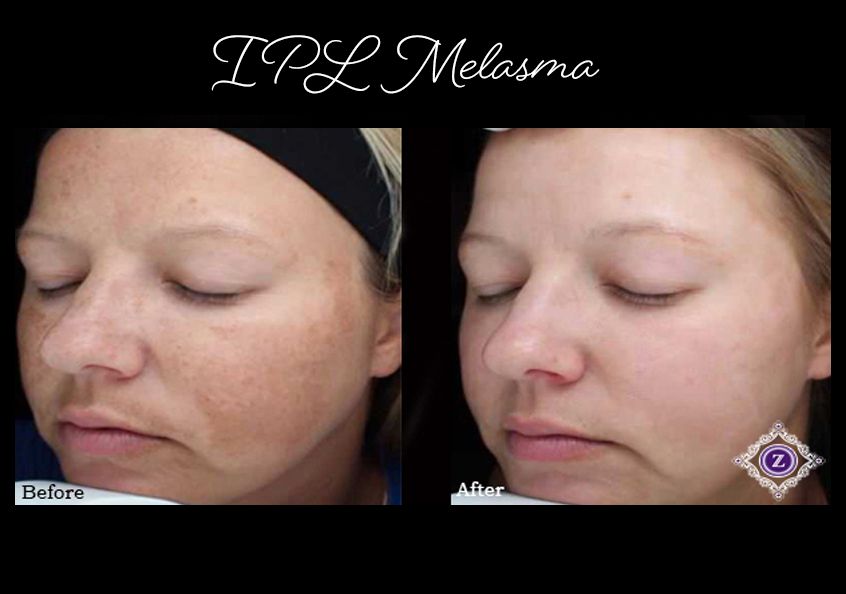 Age spot removal, IPL laser treatment, Baton Rouge, Dr. Z