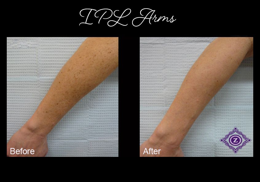 Age spot removal, IPL laser treatment, Baton Rouge, Dr. Z