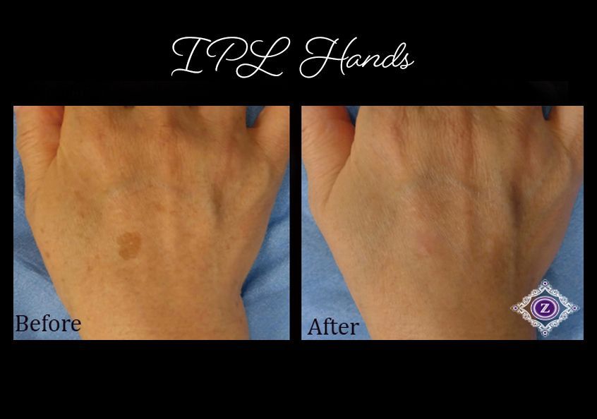 Age spot removal, IPL laser treatment, Baton Rouge, Dr. Z