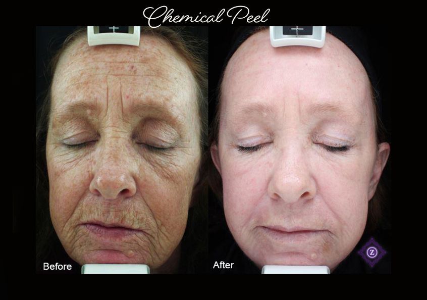 Before and After Chemical Peel Skin Treatment Baton Rouge Patient at Z Aesthetic Dermatology 