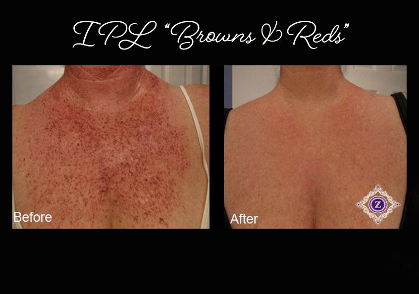 Age spot removal, IPL laser treatment, Baton Rouge, Dr. Z