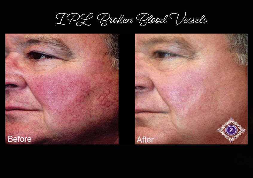 Age spot removal, IPL laser treatment, Baton Rouge, Dr. Z