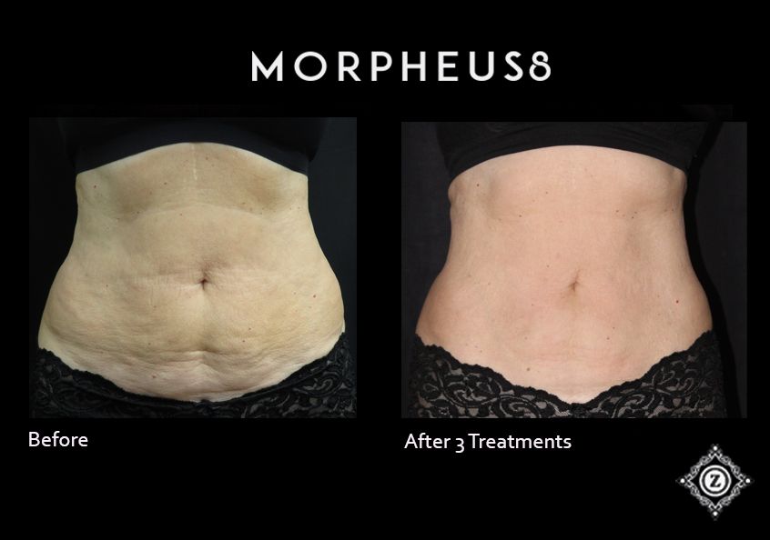 Baton Rouge Microneedling Before and After Z Dermatology
