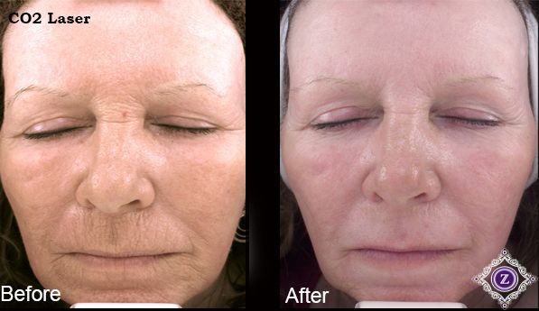 Wrinkle treatment before and after, CO2 Baton Rouge, Dr. Z
