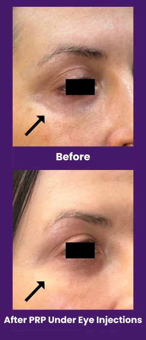 PRP under eye injections before and after, Dr. Z