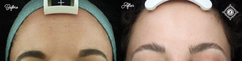 Botox Baton Rouge Before and After for Forehead Wrinkles at Z Aesthetic Dermatology