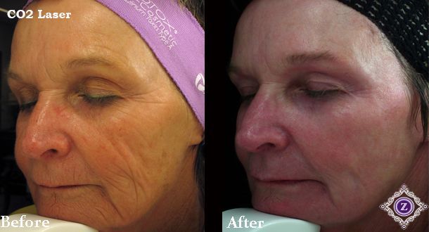 Baton Rouge Microneedling Before and After Z Dermatology