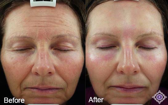 CO2 laser skin resurfacing Baton Rouge before and after, Dr. Z