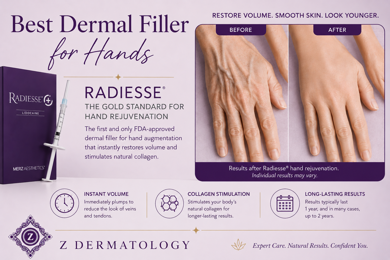 Radiesse hand rejuvenation treatment restoring volume and reducing visible veins and tendons on hand