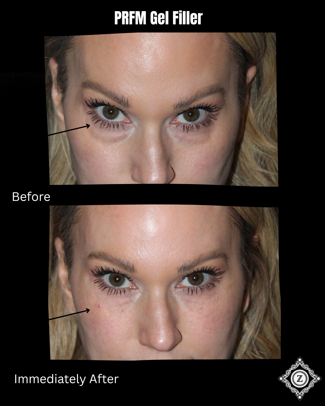 PRP under eye injections before and after, Dr. Z