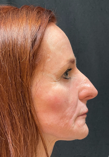Dermal filler nose before and after, Dr. Z
