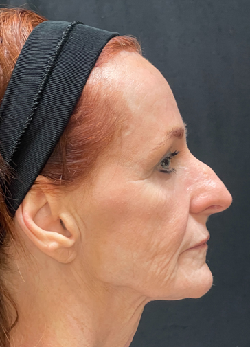 Dermal filler cheekbones before and after, Dr. Z