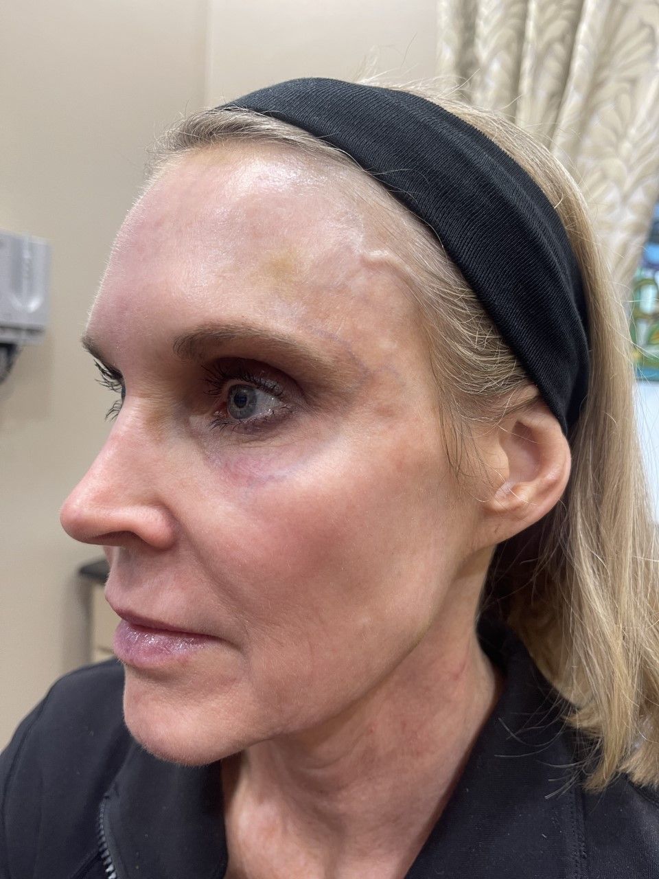 After dermal filler treatment results at Z Aesthetic Dermatology Baton Rouge Louisiana
