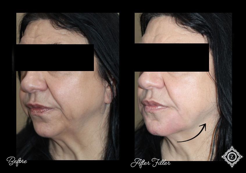 marionnette filler baton rouge before and after