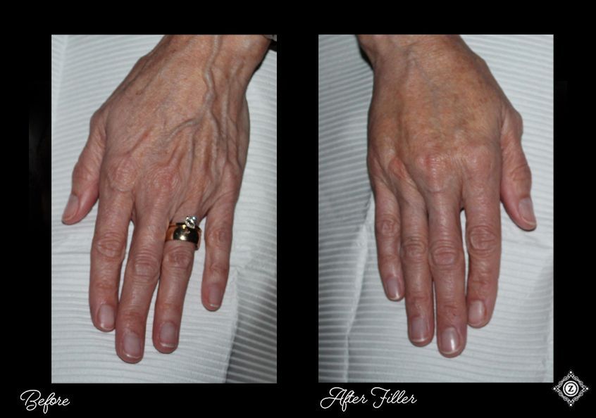 Restylane Filler for Hands Baton Rouge before and after, Dr. Z