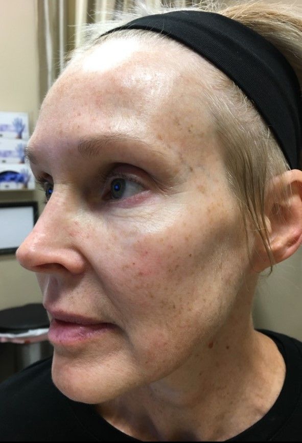 Before dermal filler treatment at Z Aesthetic Dermatology Baton Rouge Louisiana