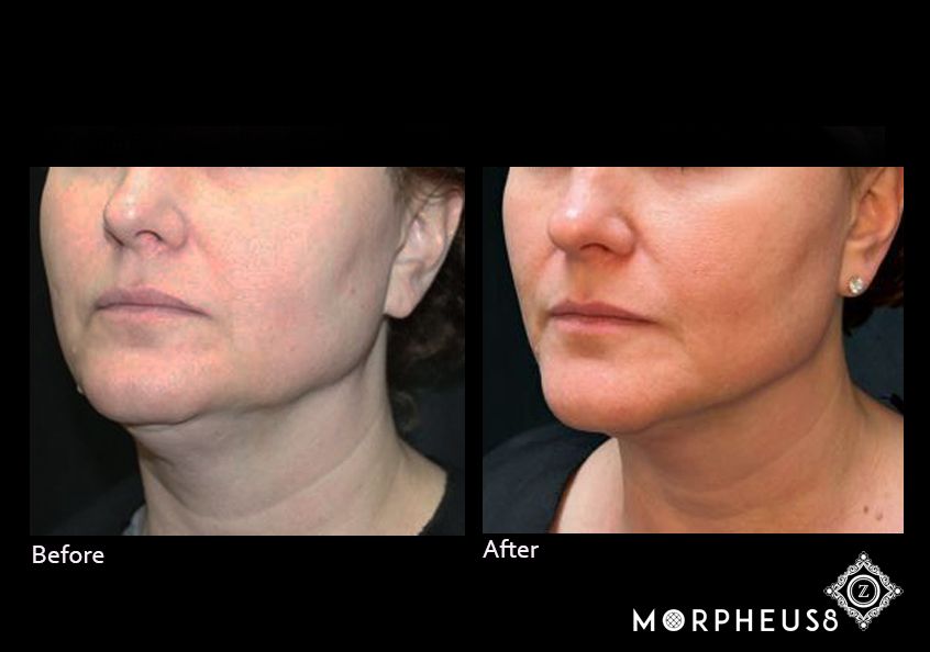 Baton Rouge Microneedling Before and After Z Dermatology