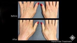 Restylane Filler for Hands Baton Rouge before and after, Dr. Z