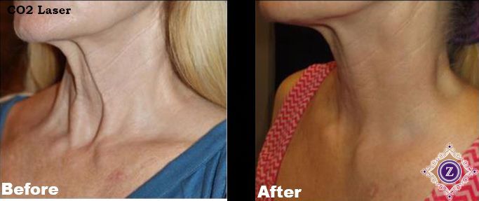CO2 laser skin resurfacing Baton Rouge before and after, Dr. Z