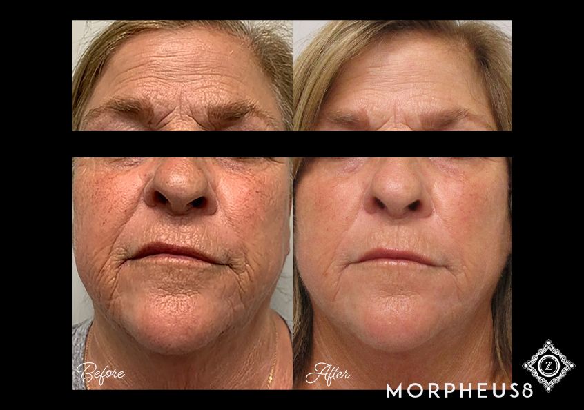 Baton Rouge Microneedling Before and After Z Dermatology
