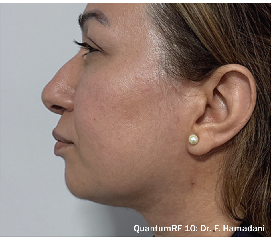 QuantumRF skin tightening treatment at Z Dermatology in Baton Rouge