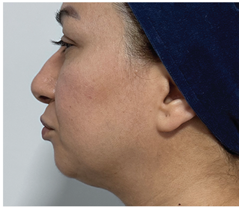 QuantumRF skin tightening treatment at Z Dermatology in Baton Rouge