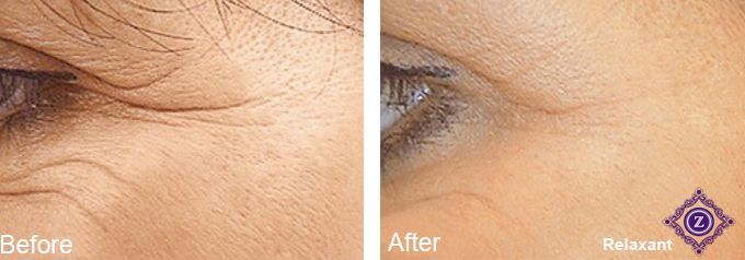Botox Baton Rouge Before and After for Crows Feet at Z Aesthetic Dermatology