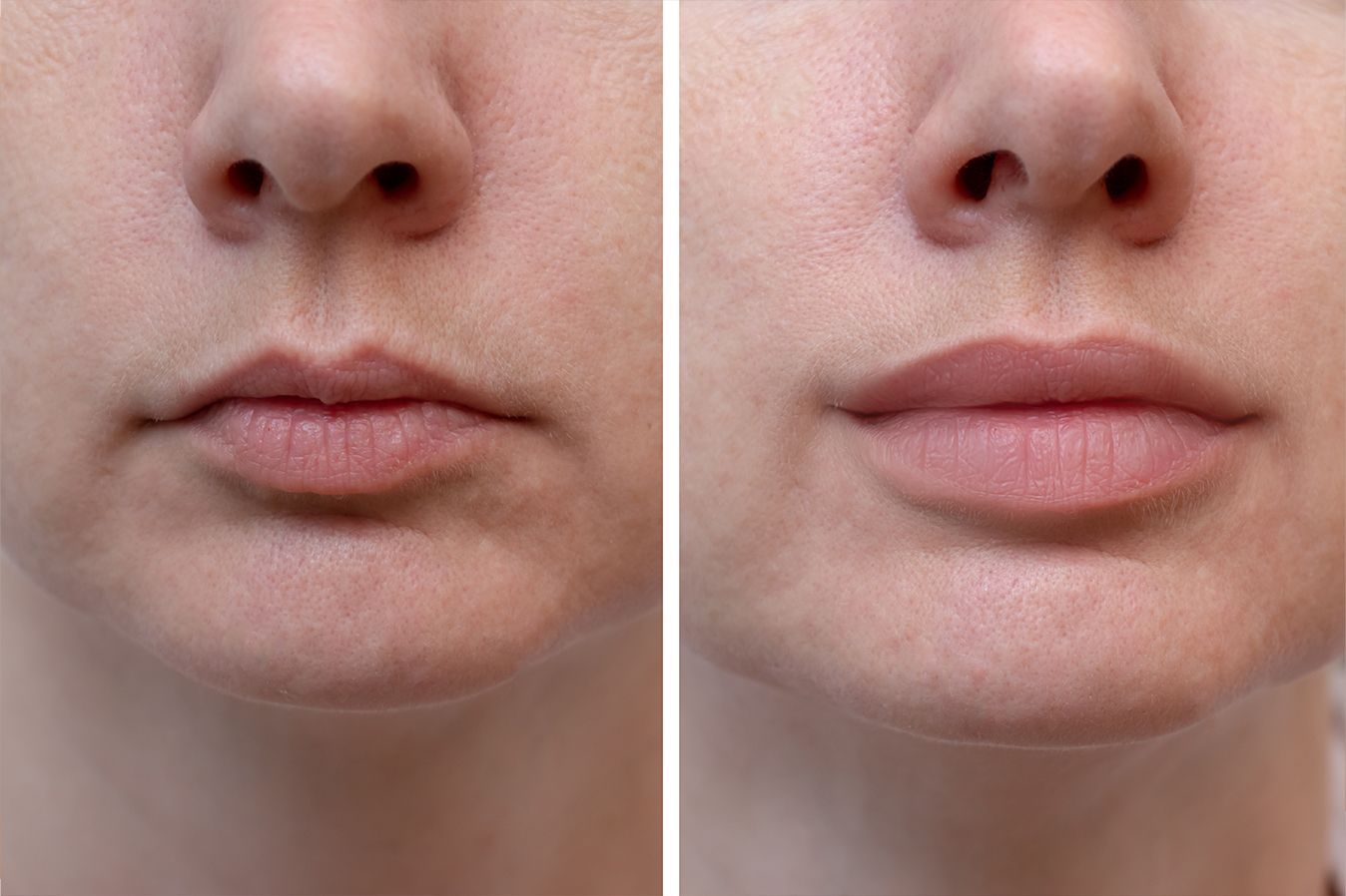 Lip filler Baton Rouge before and after, Dr. Z