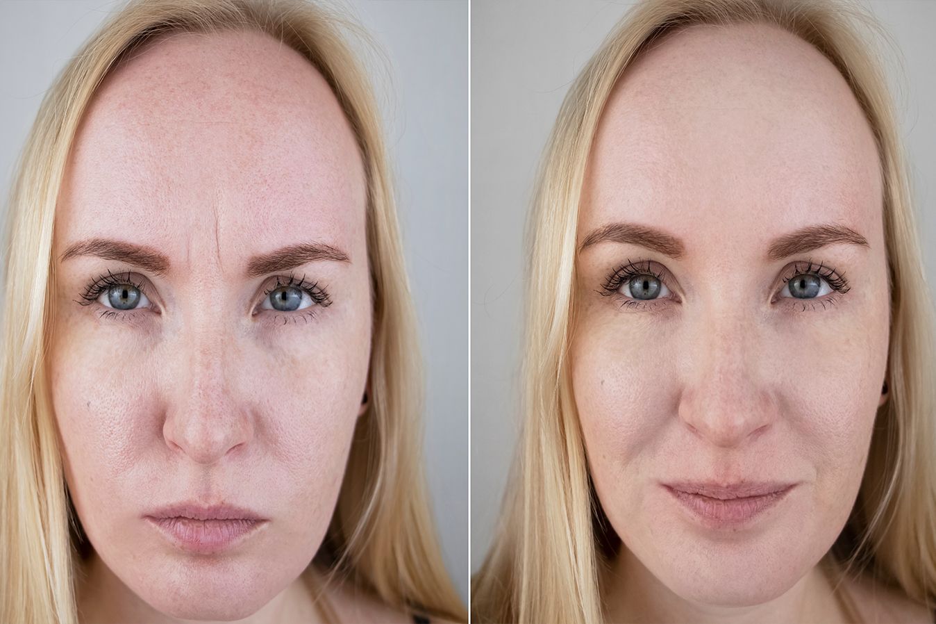Botox forehead lines before and after, Dr. Z, Baton Rouge