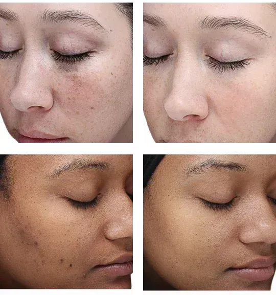 Improved skin tone and glow after VI Peel treatment