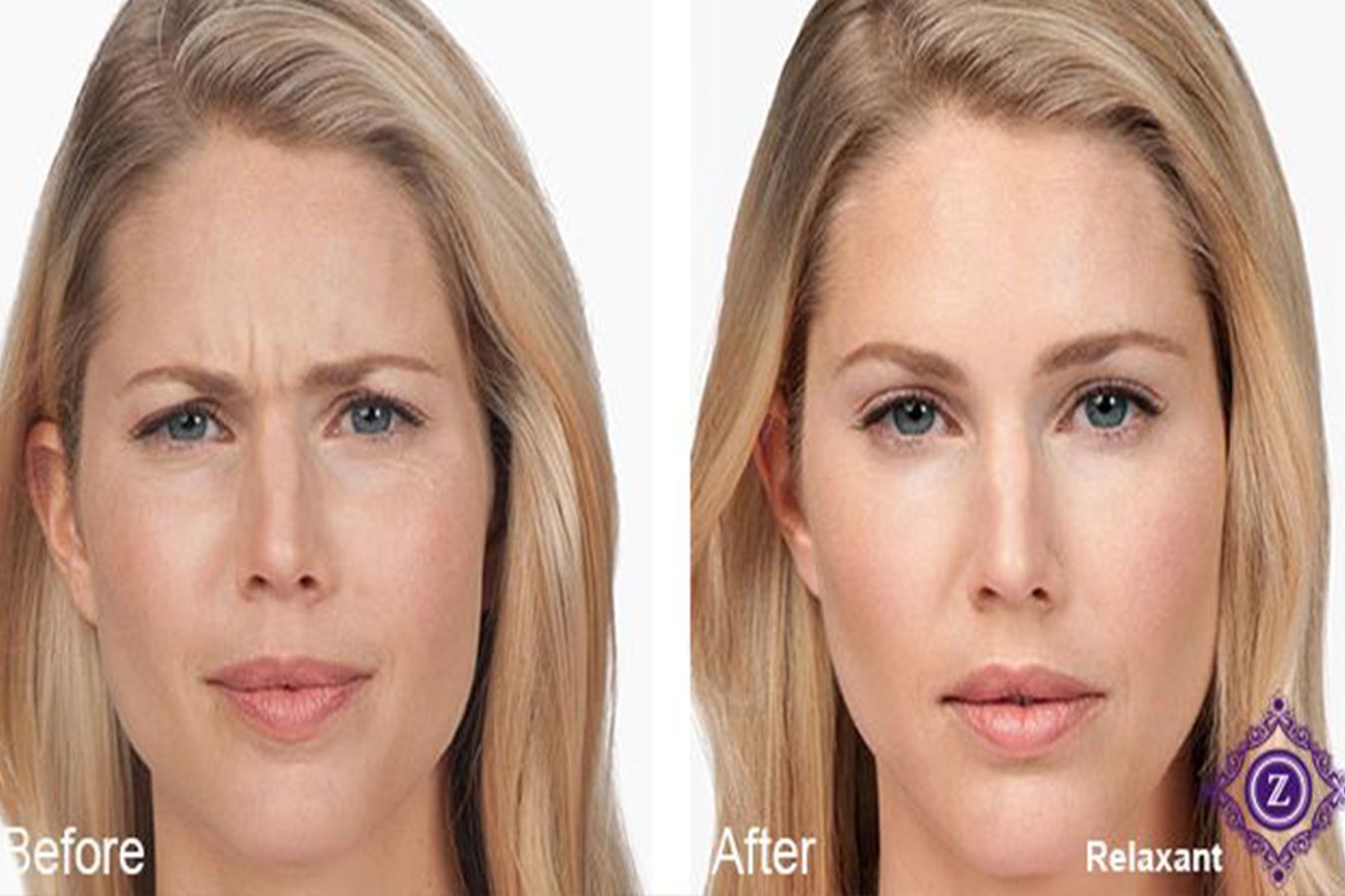 Preventative Botox in Baton Rouge, LA at Z Dermatology.