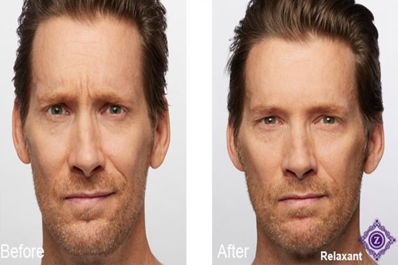 Brotox in Baton Rouge, LA, Mens Botox Injections at Z Dermatology.