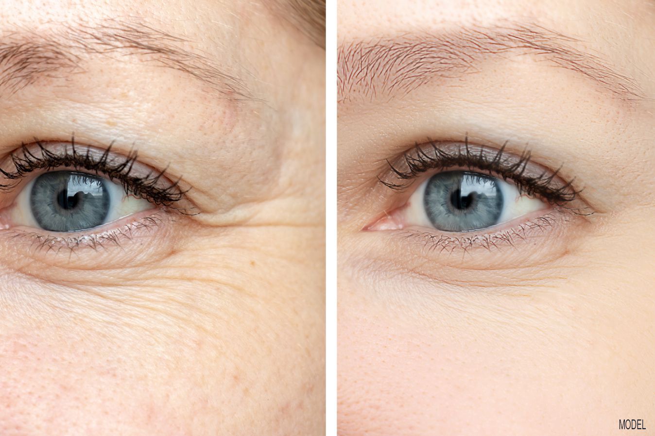 Botox before and after, Dr. Z, Baton Rouge