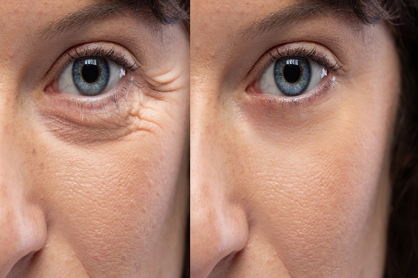 Baton Rouge Botox crow before and after treatment by Dr. Z