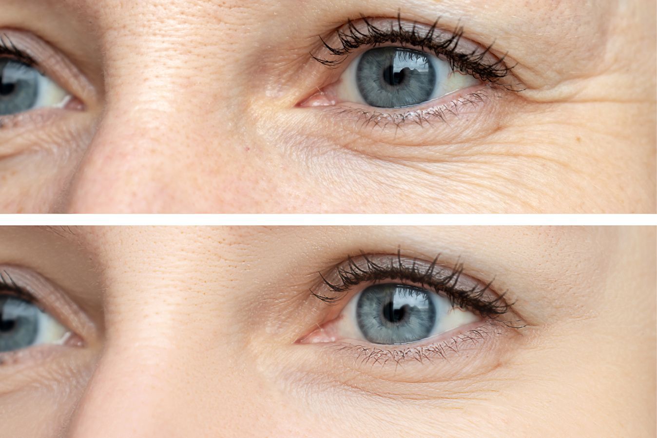 Baton Rouge Botox before and after, Dr. Z