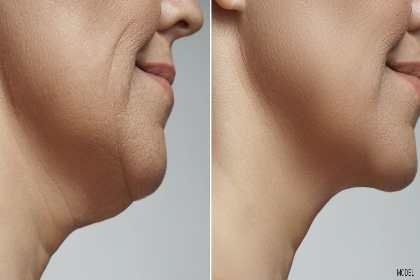 Botox neck lift treatment before and after, Dr. Z, Baton Rouge