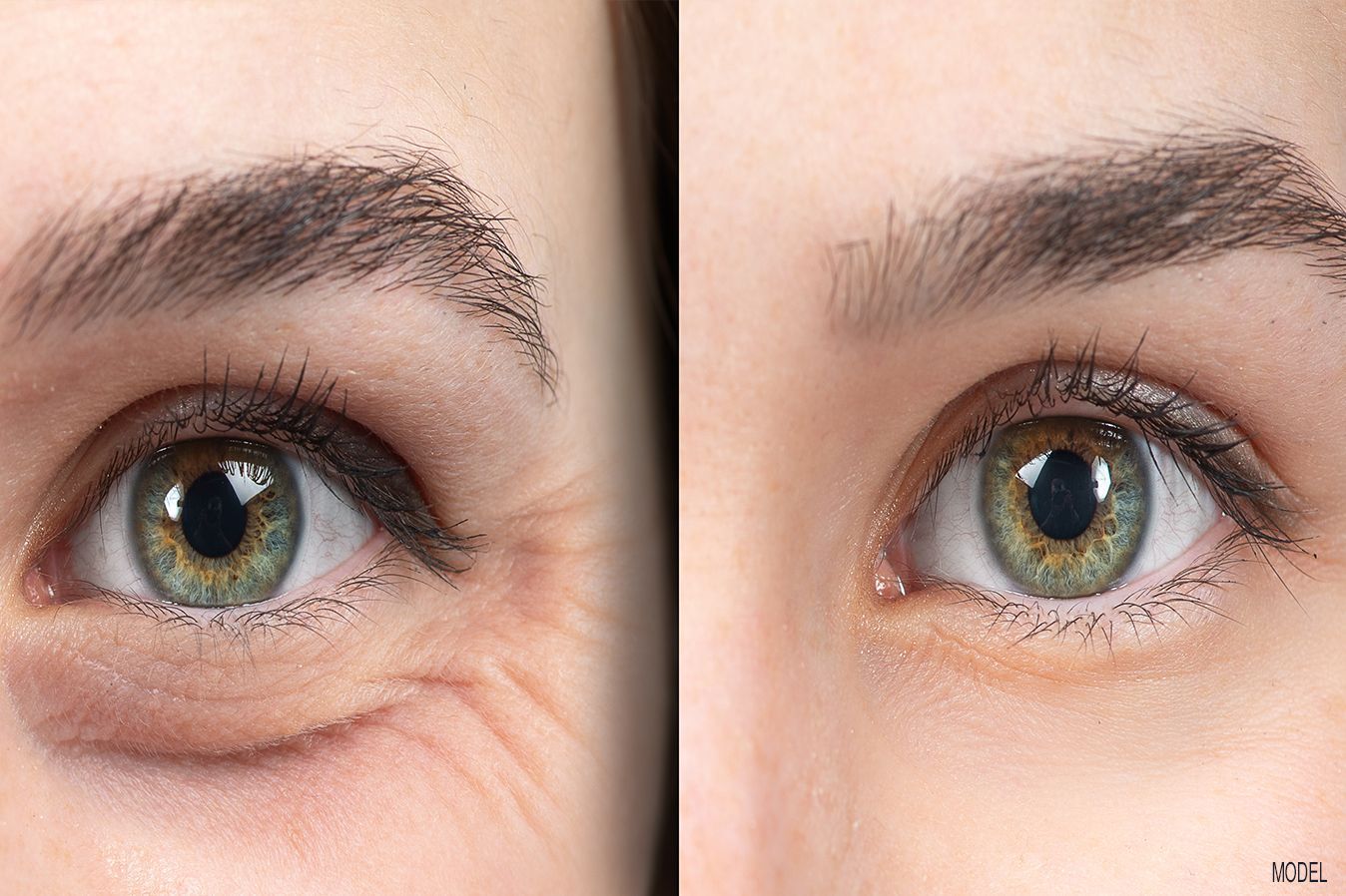 Brow Lift treatment in Baton Rouge, LA at Z Dermatology with Botox.