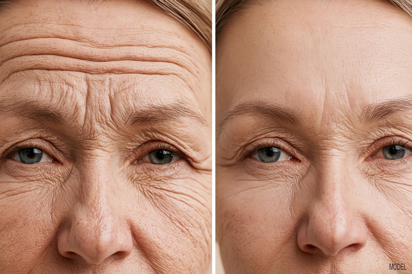 Forehead Lines treatment in Baton Rouge, LA with Botox at Z Dermatology.